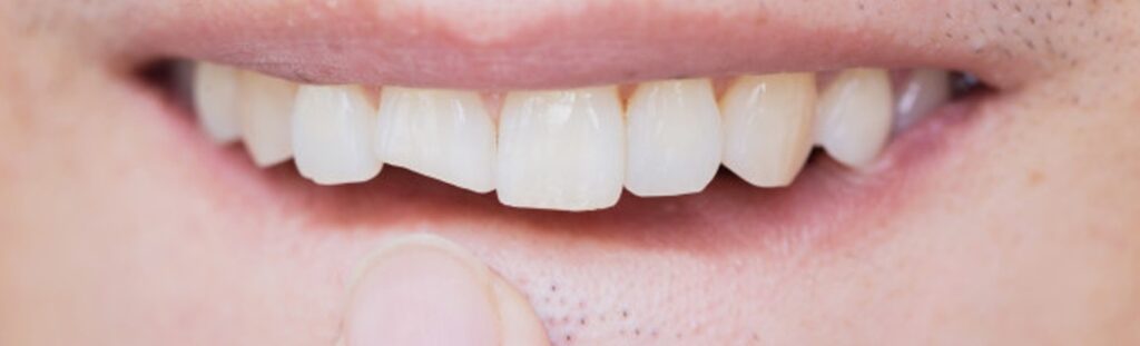 Identifying Cracked Tooth Syndrome: Techniques for Detection