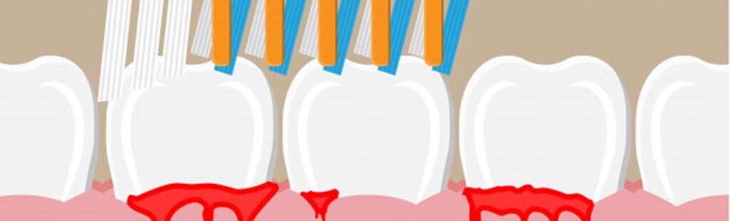 Stop the Bleed: Your Guide to Preventing and Treating Bleeding Gums