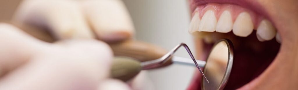 Scaling Back to Health: The Importance of Tooth Scaling in Dental Care